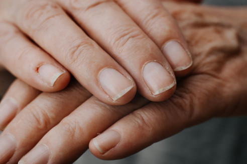 Uitați-vă la unghiile dumneavoastră pentru a vedea dacă aveți semne de cancer