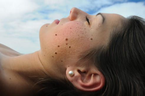 Waspadai, Perubahan Tahi Lalat Tanda Melanoma