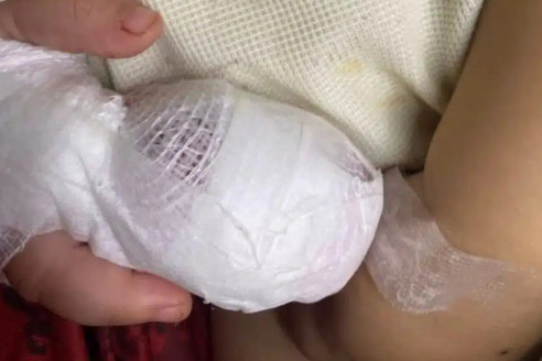 В Таиланде годовалому ребёнку отрезали кончик пальца перед выпиской из больницы